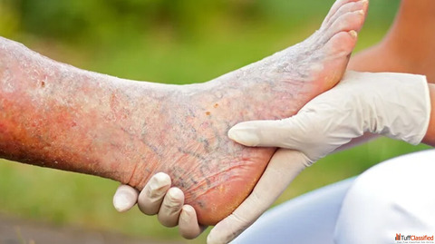 Stem Cell Treatment for Critical Limb Ischemia