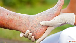 Stem Cell Treatment for Critical Limb Ischemia