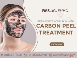 Carbon Peel Laser Treatment in Hyderabad