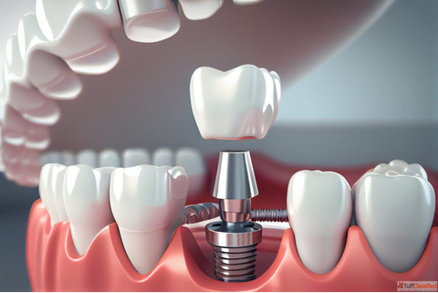 Quality Dental Implants in India