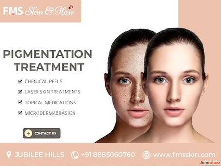 Best Pigmentation Treatment in Hyderabad