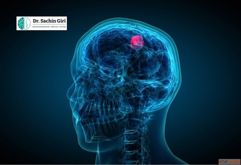 Advanced Pediatric Brain Tumor Surgery in Mumbai by Dr. Sachin Giri