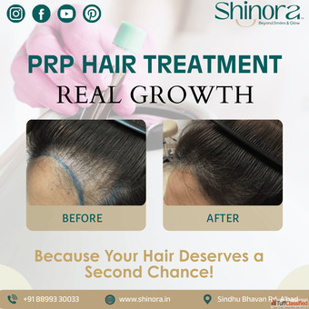 Best PRP Hair Treatment in Ahmedabad for Healthy Strong Hair