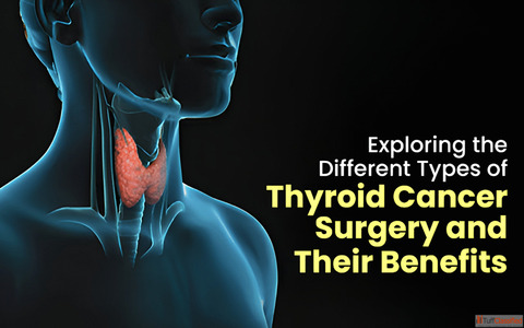 Best Thyroid Cancer Treatment in Delhi
