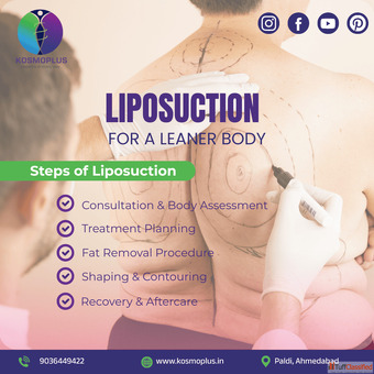 Best Liposuction Surgery in Ahmedabad at KosmoPlus