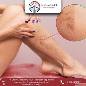 Best Peripheral Arterial Disease Treatment in India by Dr.Krunal Gohil