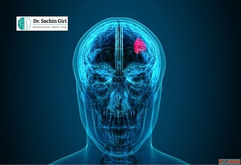 Brain Tumor Removal Surgery in Mumbai by Dr. Sachin Giri