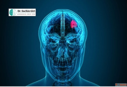 Brain Tumor Removal Surgery in Mumbai by Dr. Sachin Giri