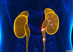 Kidney Stone Treatment in Mumbai Dr Chandan Chaudhari - Expe...