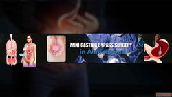 Mini Gastric Bypass Surgery for Weight Management in Ahmedab...