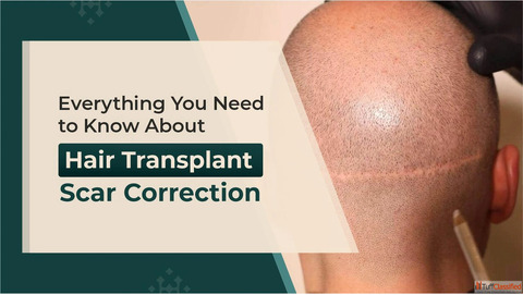 Everything You Need to Know About Hair Transplant Scar Correction