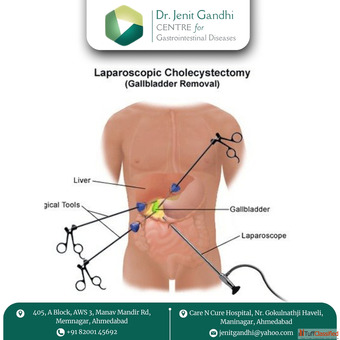 Best Gallbladder Surgeon in Ahmedabad India with Modern Techniques