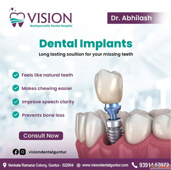 Dental Implants in Guntur - Permanent Solution for Missing Teeth