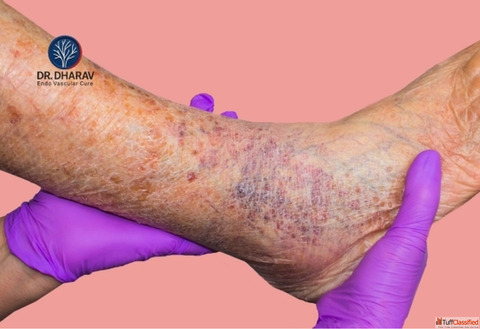 Varicose Veins Specialist in India - Dr. Dharav Kheradia