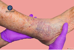 Varicose Veins Specialist in India - Dr. Dharav Kheradia