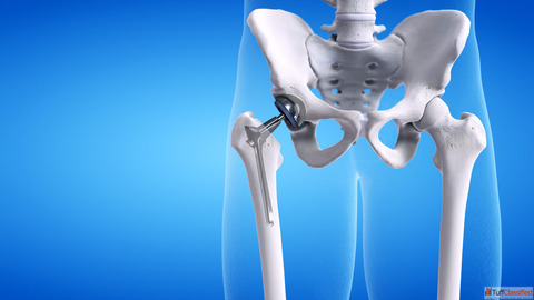 Hip Replacement Surgeon - Best Orthopedic Surgeon in Lucknow Dr. C. P. Gupta