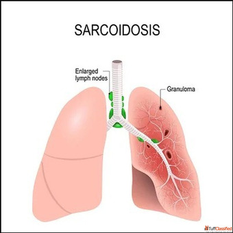 Sarcoidosis Specialist in Jaipur Rajasthan Advanced Lung Care