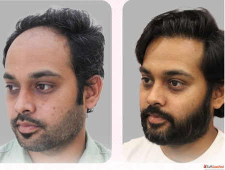 Best Hair transplant in delhi