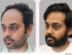 Best Hair transplant in delhi