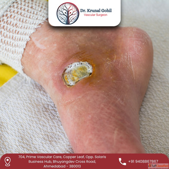 Best Diabetic Foot Treatment in India - Dr. Krunal Gohil