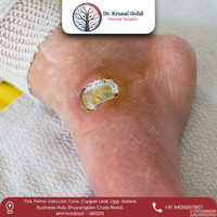Best Diabetic Foot Treatment in India - Dr. Krunal Gohil