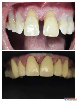 Dental Hospital in Vaishali Nagar Teeth Braces Jaipur Dental Implants in Jaipur