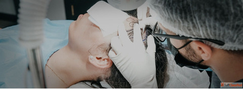 Safe Natural and Permanent Female Hair Transplant