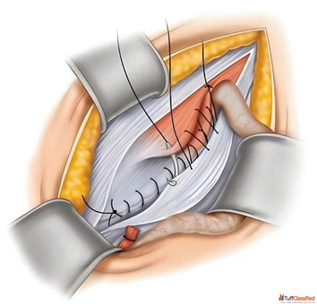 Dr. Vishal Soni - Best Hernia Surgeon in Ahmedabad Trusted Hernia Care