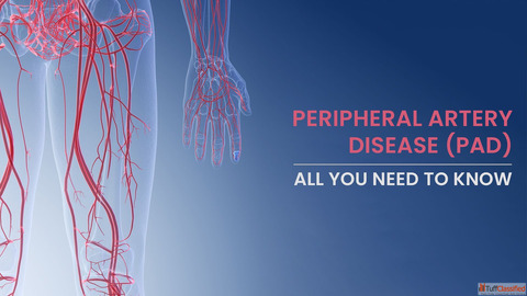 Management of Peripheral Arterial Disease Effective Diagnosis and Treatment Options