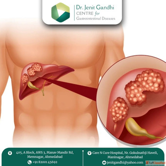 Dr. Jenit Gandhi - Advanced liver cancer treatment in Ahmedabad India