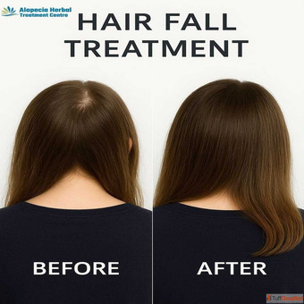 Effective Hair Loss Treatment in Noida with Herbal Care