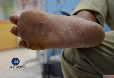 Trusted Diabetic Foot Surgeon in India - Dr Dharav Kheradia