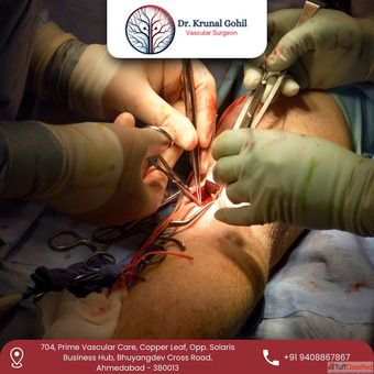 Advanced AV Fistula Care in India by Dr. Krunal Gohil