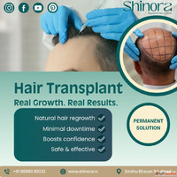 Advanced Hair Restoration in Ahmedabad - Shinora Clinic