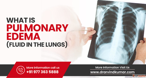 Pulmonary Edema Fluid In The Lungs- Dr. Arvind Kumar