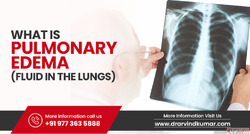Pulmonary Edema Fluid In The Lungs- Dr. Arvind Kumar