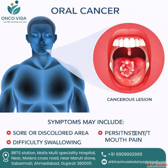 Oral Cancer Surgery in Ahmedabad by Expert Surgeon