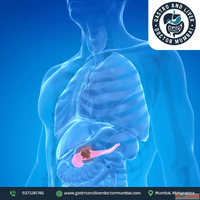 Advanced Pancreatic Cancer Treatment in Mumbai with Expert C...
