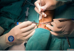 Specialized AV Fistula Treatment in India with Expert Care b...