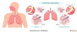 ILD Specialist in Jaipur Rajasthan Interstitial Lung Disease...