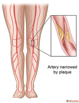 Peripheral Arterial Doppler Test Accurate Diagnosis of Peripheral Artery Disease