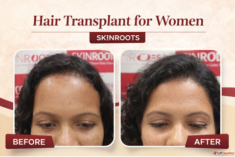 Hair Transplant for Women - Safe Effective Solutions