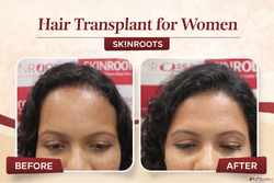 Hair Transplant for Women - Safe Effective Solutions