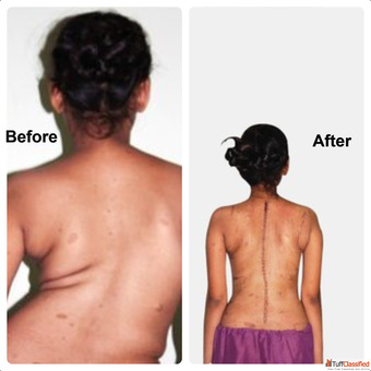 Scoliosis Treatment in Vizag - Dr. B. Leela Prasad
