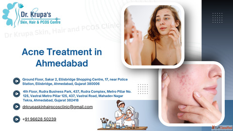 Acne Treatment in Ahmedabad Gujarat Clear Skin Begins with Expert Care