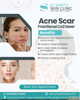 Clear Acne-Free Skin Starts Here in Secunderabad
