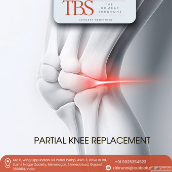 Best Partial Knee Replacement in Ahmedabad with Dr. Krunal Soni