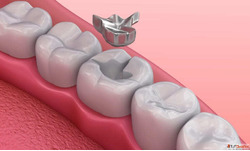 Dental Teeth Filling Treatment Dentist Gangapur Road Nashik