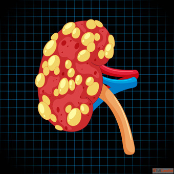 What Are the Signs of Kidney Failure and Can Homeopathy Help