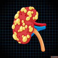 What Are the Signs of Kidney Failure and Can Homeopathy Help